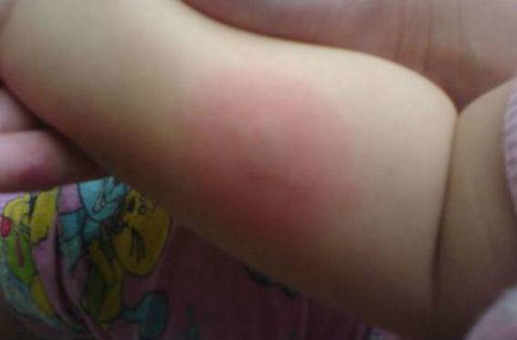 Реакция манту для детей с аллергией