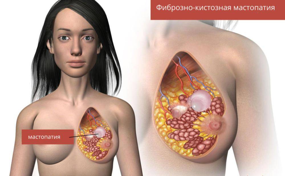 Фиброз грудной клетки: характеристики и методы лечения