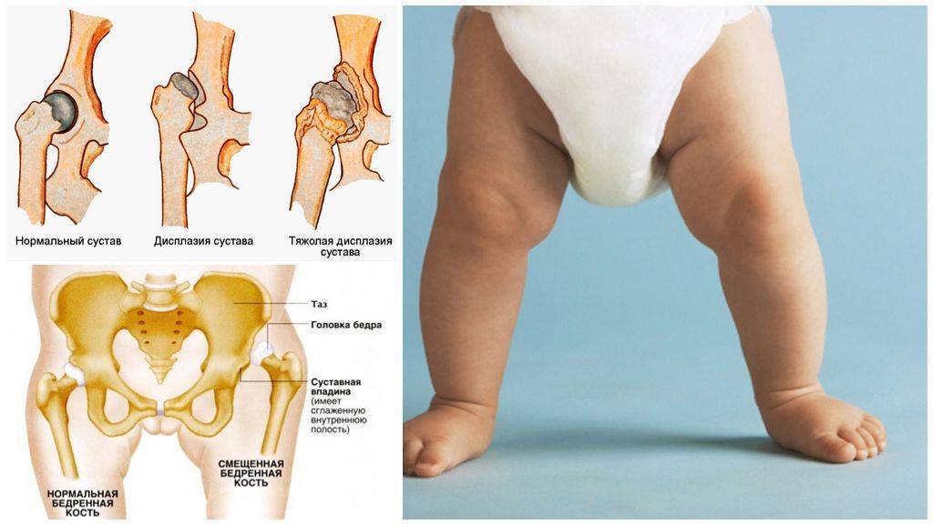 Причины артрита коленного сустава у детей, симптомы, диагностика и лечение