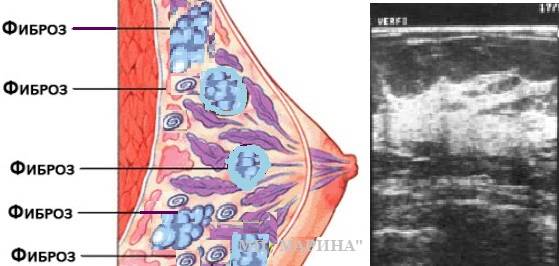 Фиброма молочной железы: причины, симптомы, диагностика и лечение