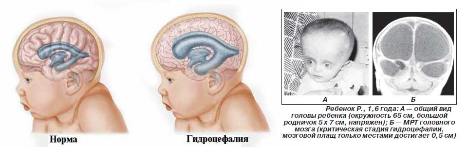 Недоразвитие зон мозга