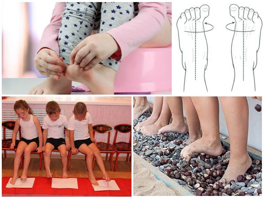 Упражнения при вальгусной деформации стопы у детей | детская поликлиника