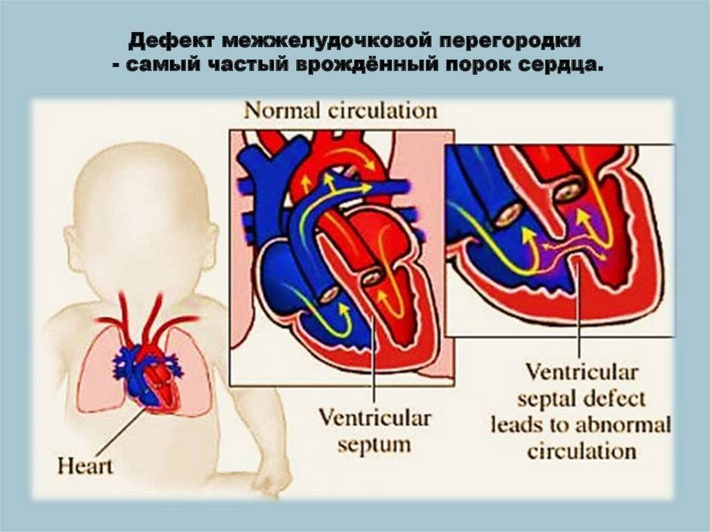 Дефект межжелудочковой перегородки презентация