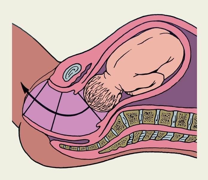 Как ускорить раскрытие шейки матки перед родами в домашних условиях: "мужетерапия" и упражнения | процесс | vpolozhenii.com