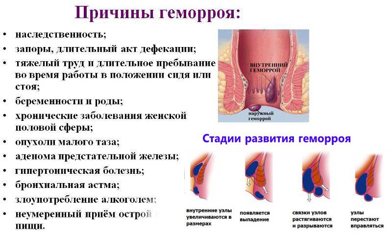 Геморрой Фото Лечение Мазь