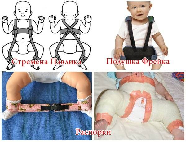 Дисплазия тазобедренных суставов у ребенка - лечение