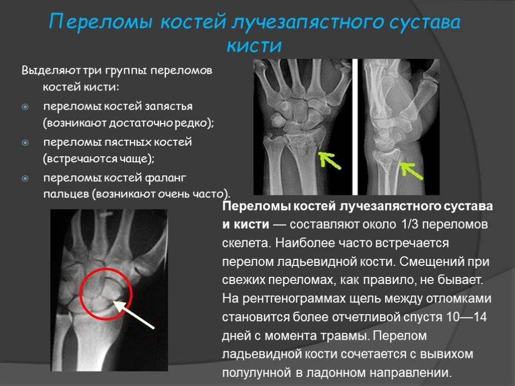 Вывих кисти. Перелом ладьевидной кости кисти описание. Полулунная кость перелом. Перелом локтевой кости запястья симптомы. Перелом полулунной кости рентген.