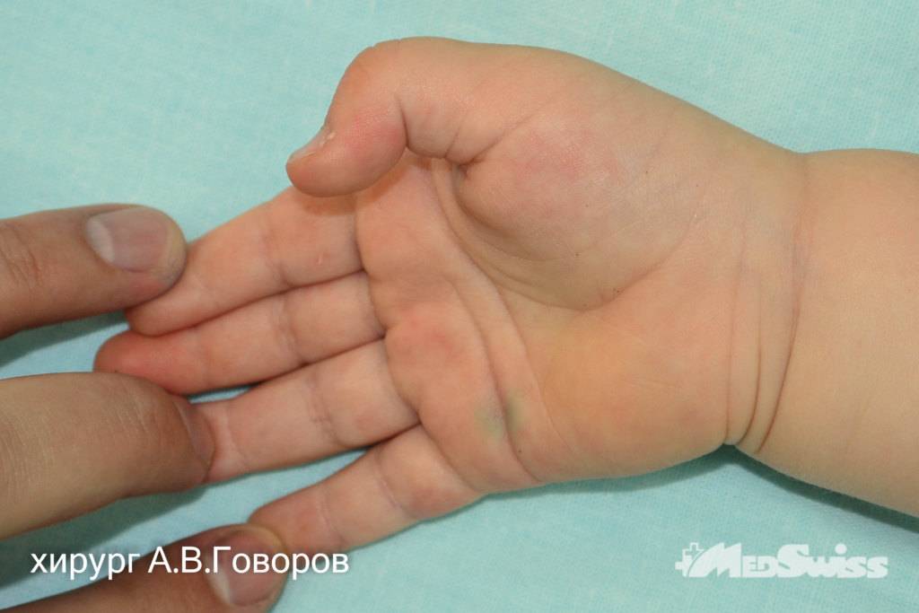 Неврологические заболевания у детей
