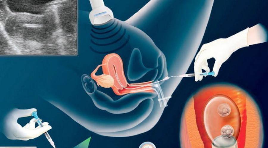 Как нужно вести себя после переноса эмбрионов - статья репродуктивного центра «за рождение»