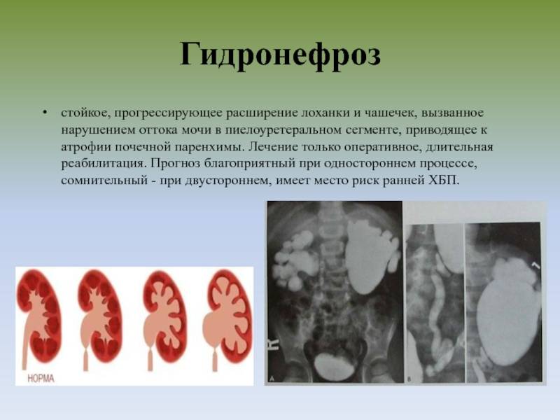 Аплазия почки. агенезия почки.дистопия почки.подковообразная почка.