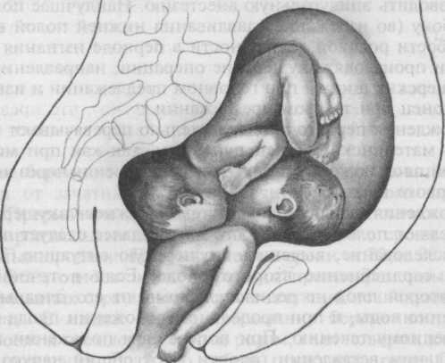 Многоплодная беременность. часть 2