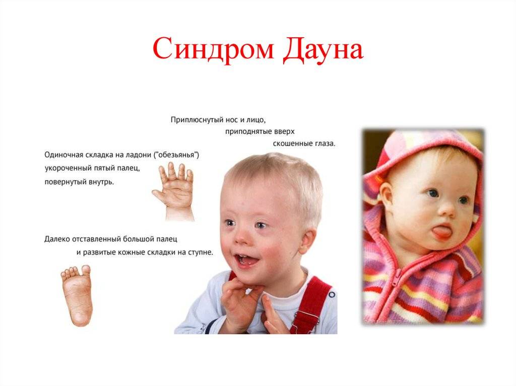 Мозаичный синдром дауна: особенности болезни и пациентов с таким диагнозом, диагностика и лечение, советы родителям