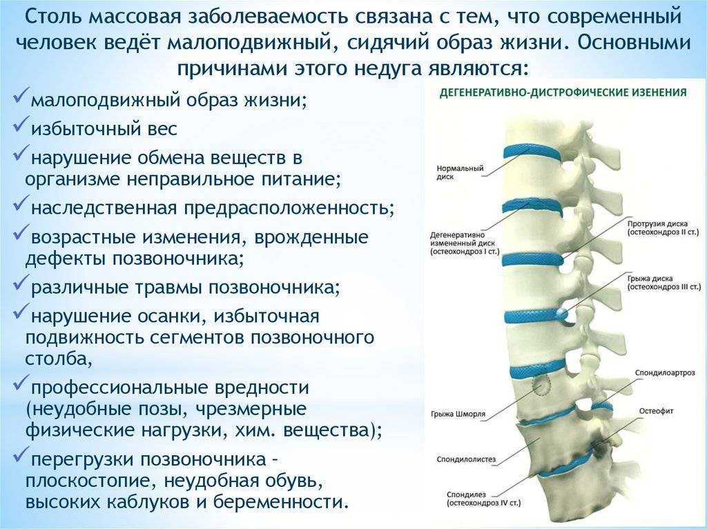 Грудной остеохондроз