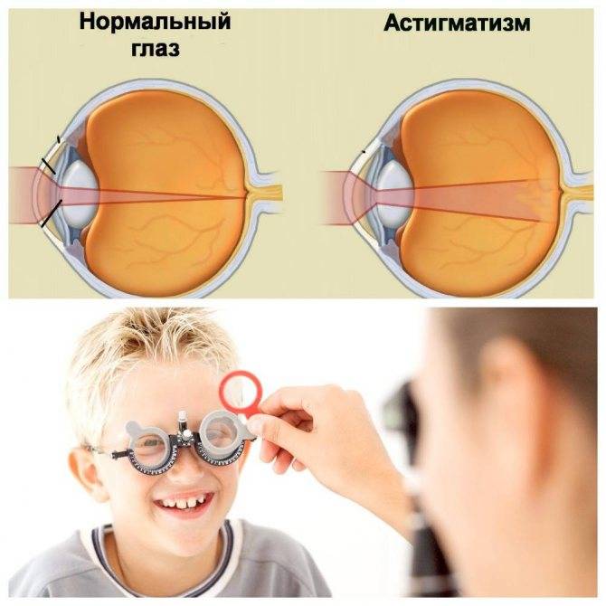 Современные способы лечения миопии у детей