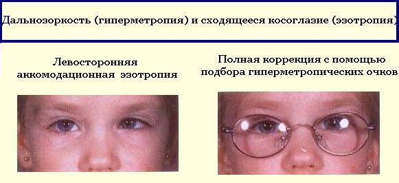 Снижение зрения у подростков: причины, симптомы, лечение