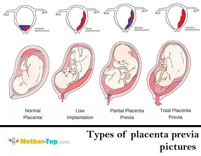 Низкая плацентация при беременности: симптомы, чем грозит и как лечить