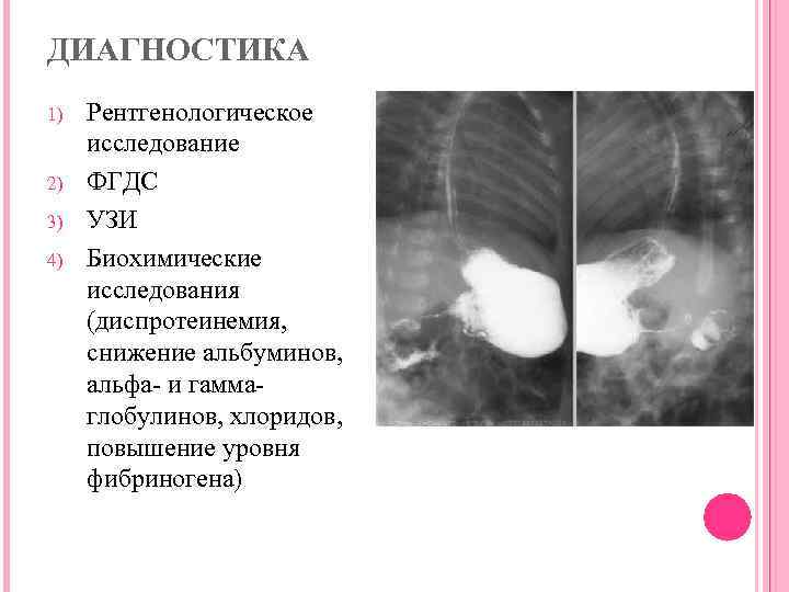 При пилороспазме клиническая картина начинается