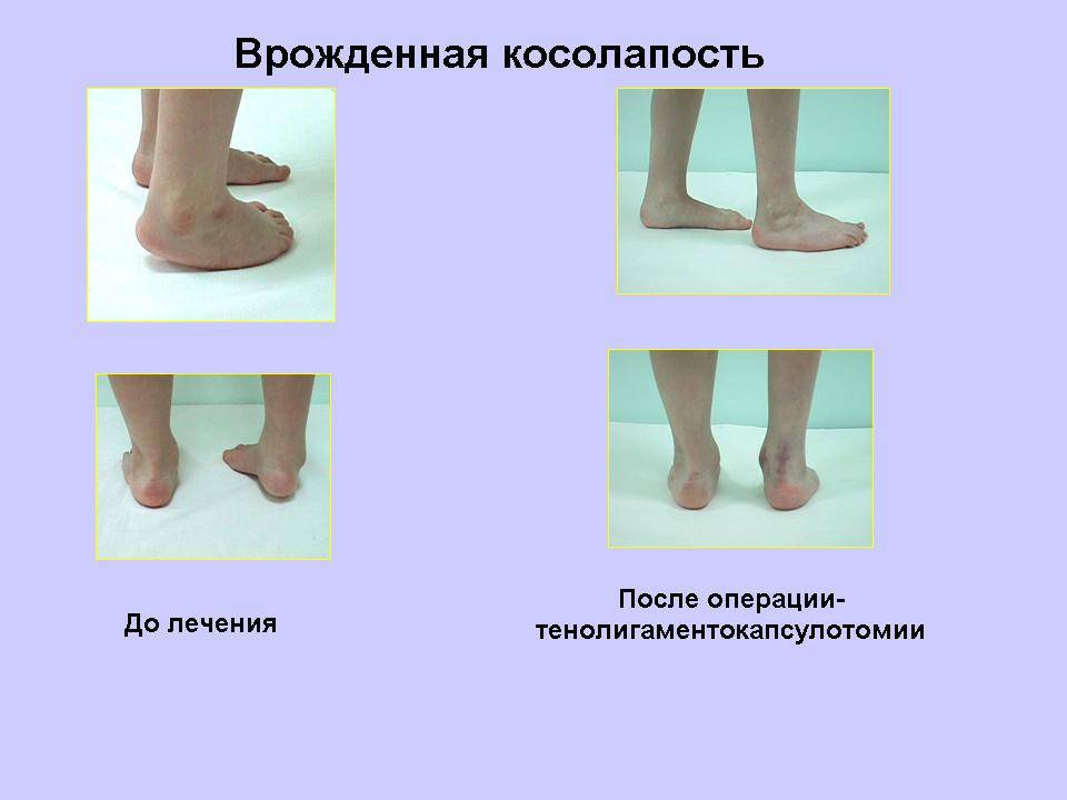 Плоско-вальгусная деформация стопы – как лечить - beautyvertebro.com