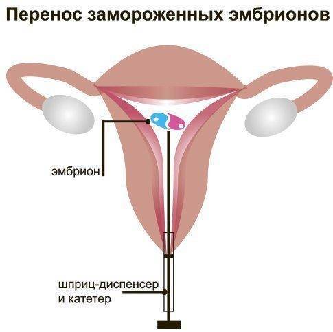 Беременность после лапароскопии | клиника "центр эко" в москве