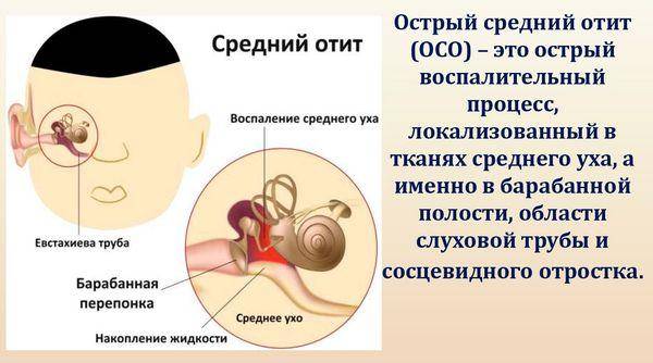 Средний отит (воспаление среднего уха): симптомы и лечение – напоправку – напоправку