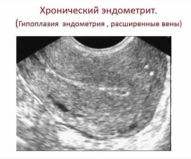Эндометрий в полости матки