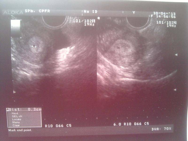 УЗИ 2 недели беременности: фото, что покажет исследование и можно ли увидеть эмбрион