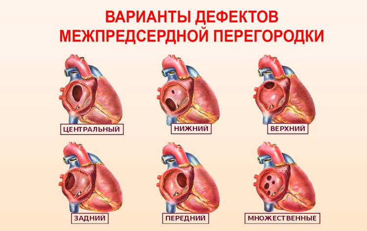 ДМПП сердца у детей (дефект межпредсердной перегородки у новорожденных): симптомы и лечение