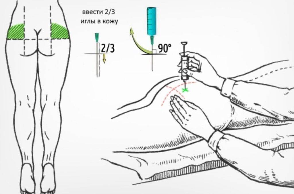 Почему болит место после укола в ягодицу. Схема введения внутримышечных уколов. Техника введения внутримышечной инъекции в ягодицу алгоритм. Введение внутримышечной инъекции в ягодицу алгоритм. Схема введения укола в ягодицы.