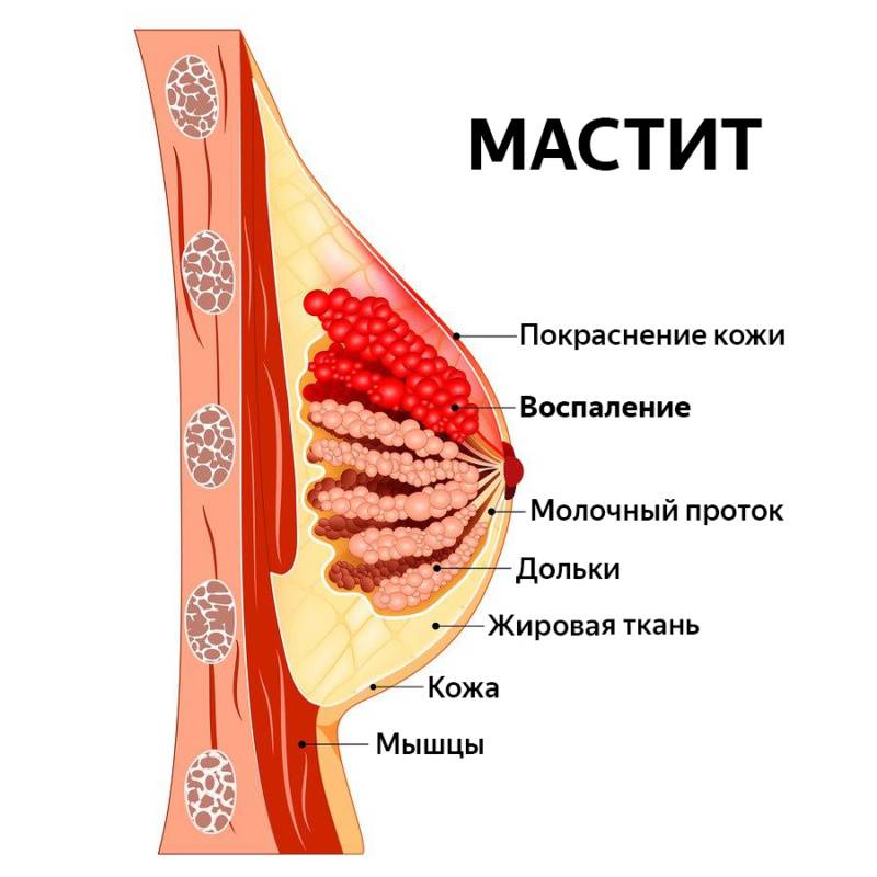 Мастит - симптоматика и лечение в зависимости от формы заболевания
