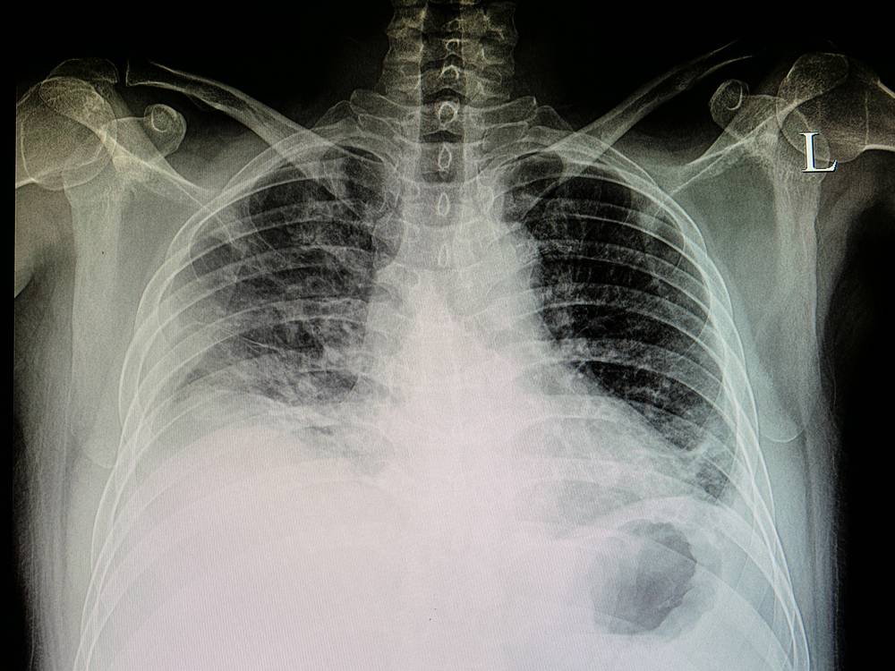 Рентген грудной клетки: особенности флюорографии