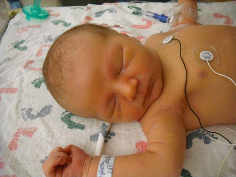 Желтуха у новорожденного: причины, последствия, лечение лампой, нормы билирубина + 50 фото
