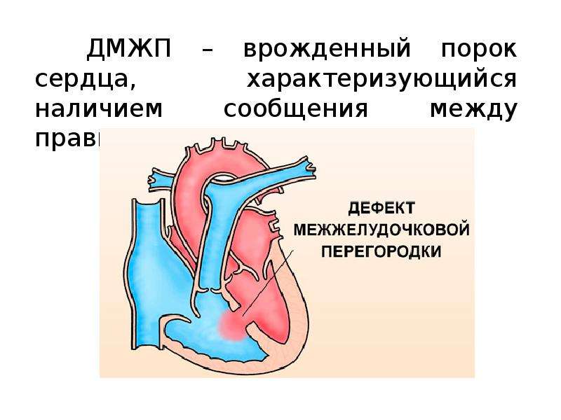 Дефект межжелудочковой перегородки у новорожденного: смертельный приговор или шанс на выздоровление?
