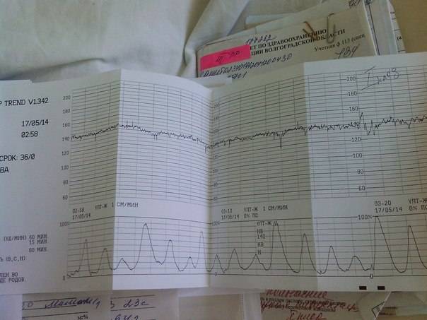 Родах расшифровка. КТГ при беременности схватки. Схватки в родах на КТГ. Схватки на КТГ как выглядят. Как выглядит схватка на КТГ.