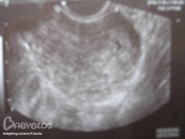 На какой неделе становится видно эмбрион на узи и почему иногда его незаметно
