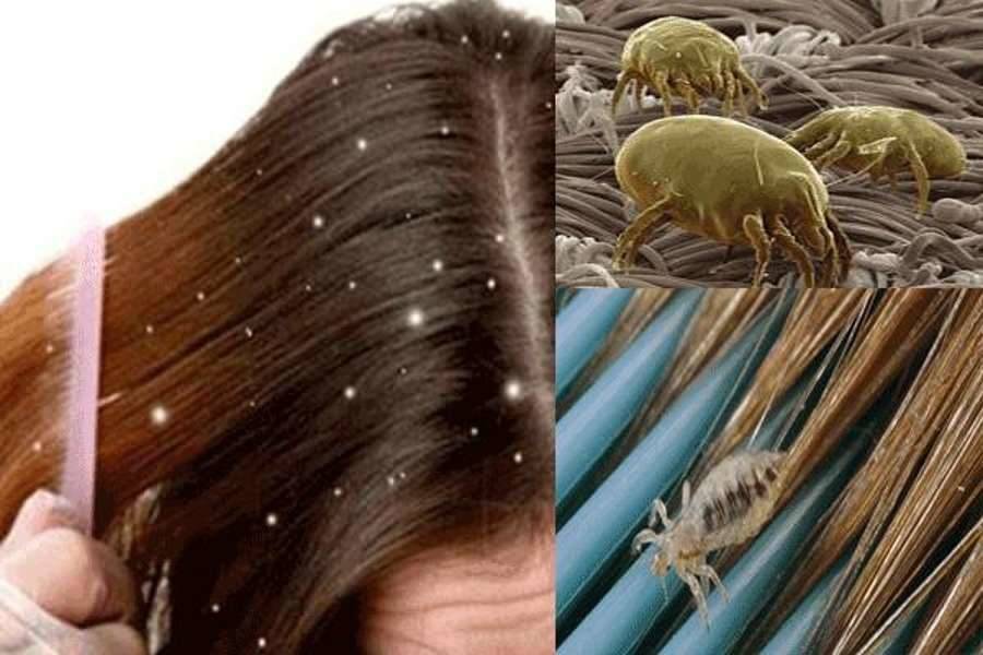 Как вывести вши у ребенка с длинными волосами: способы лечения и профилактика гнид у девочек и мальчиков