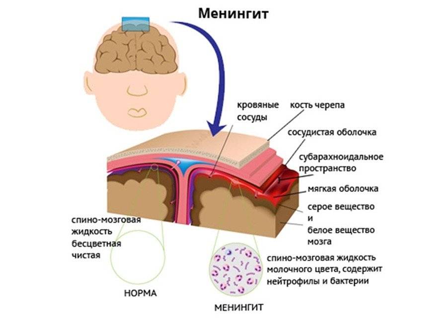 Симптомы менингита у детей: признаки вирусной инфекции с фото сыпи, лечение, последствия