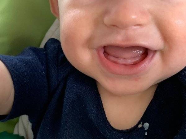 Прорезывание коренных зубов у детей - симптомы, как режутся коренные зубы