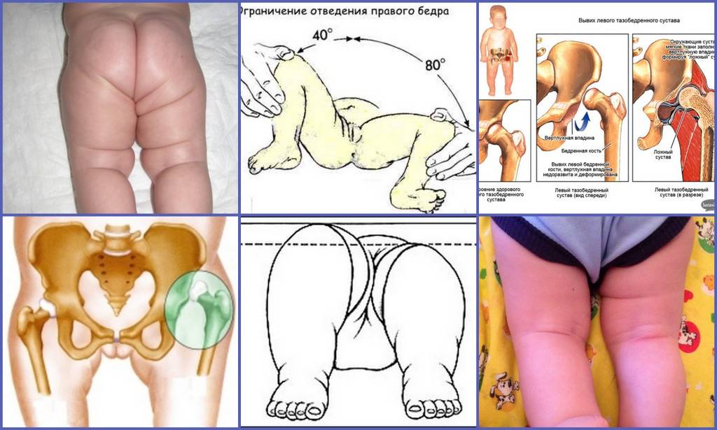 Узи тазобедренных суставов у новорожденных (при подозрении на дисплазию тазобедренного сустава)
