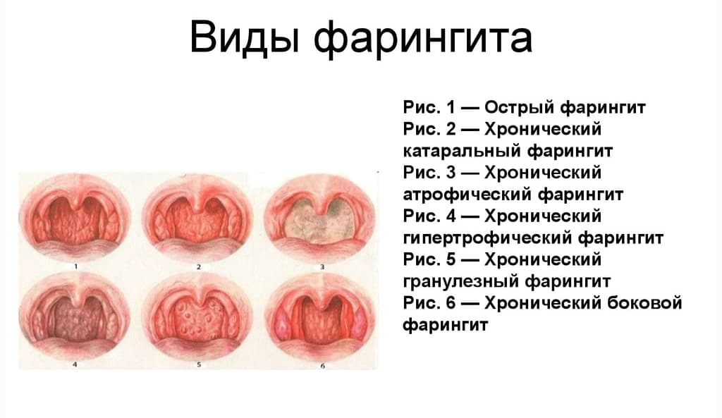 Фарингит – симптомы, лечение — государственное бюджетное учреждение здравоохранения  «научно-исследовательский клинический институт оториноларингологии им. л.и. свержевского» департамента здравоохранения города москвы