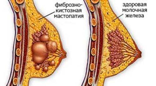Опухоли молочной железы - доброкачественные и злокачественные опухоли молочных желёз