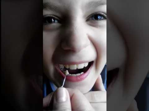 Особенности удаления зубов у детей: от показаний до нюансов процедуры