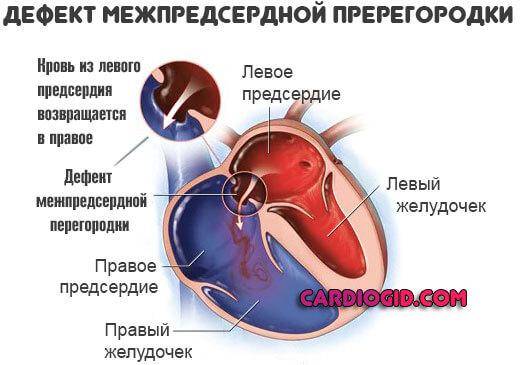 Дефект межпредсердной перегородки сердца: операция, лечение в спб