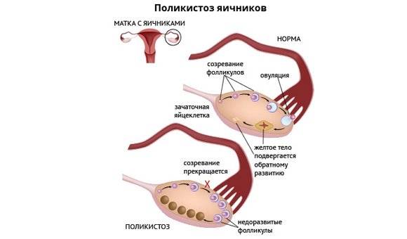 Стимуляция яичников для планирования беременности медикаментозными и народными средствами