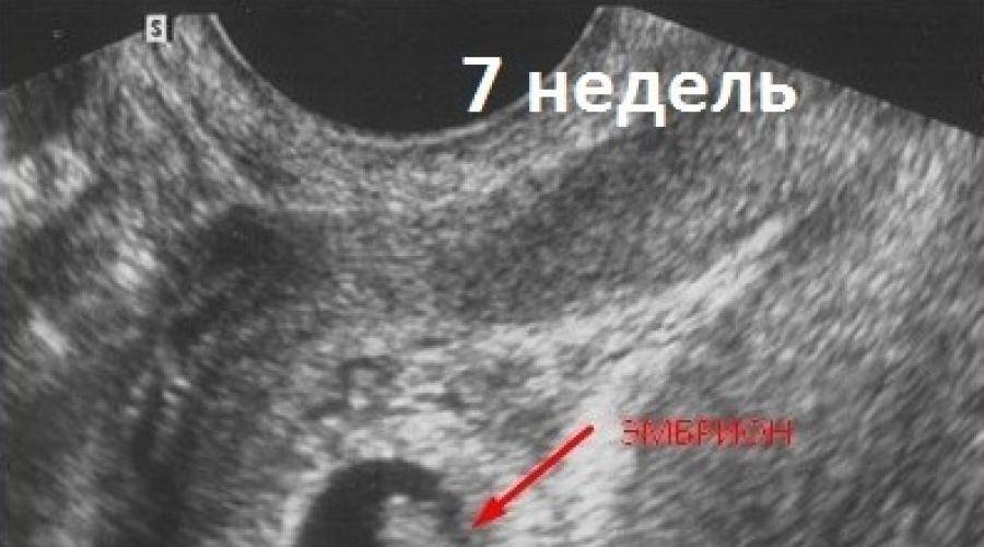 Чем необычна беременность двойней?
