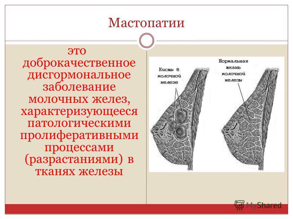 Лечение мастита у кормящей матери