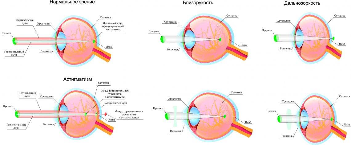 Что такое смешанный астигматизм глаз? методы лечения заболевания