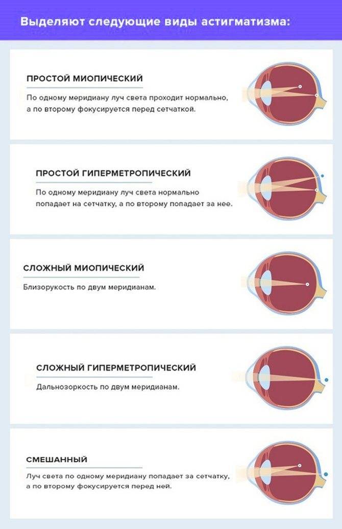 Все о смешанном астигматизме: признаки, методы коррекции зрения и лечения «ochkov.net»