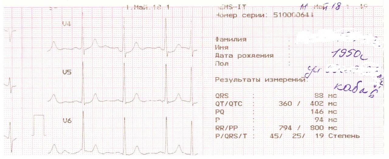 Велоэргометрия (вэм). проведение сердечного диагностического теста.