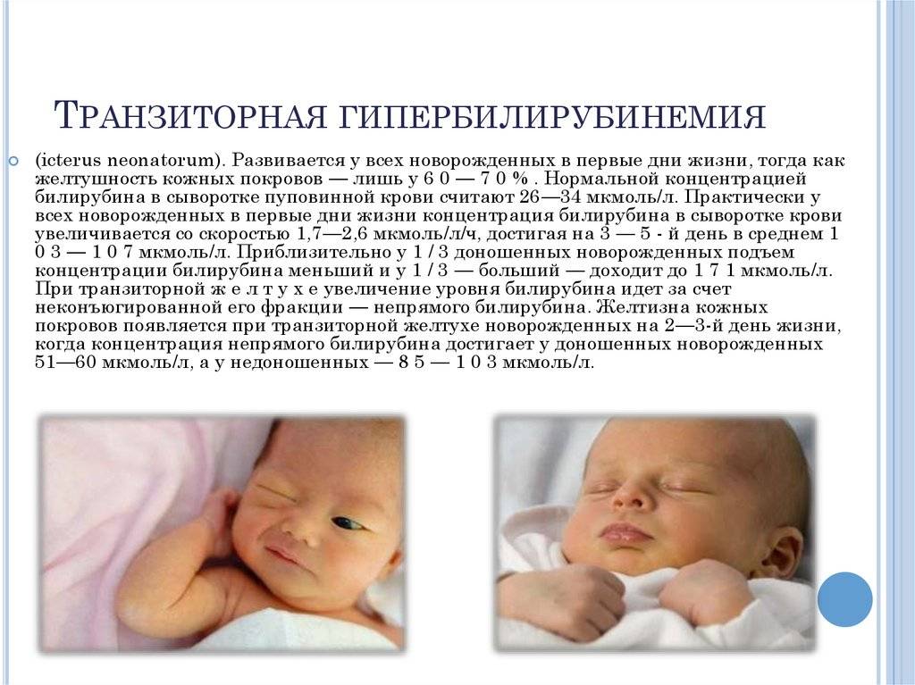 Желтуха у новорожденных – симптомы, виды, лечение