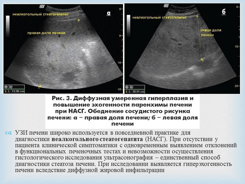 Гепатомегалия - hepatomegaly - xcv.wiki